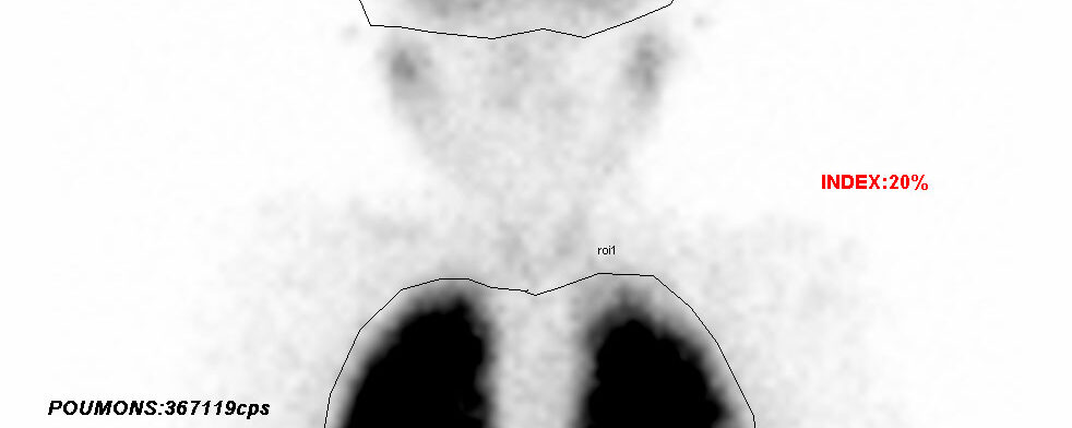 Malformation arterio-veineuse