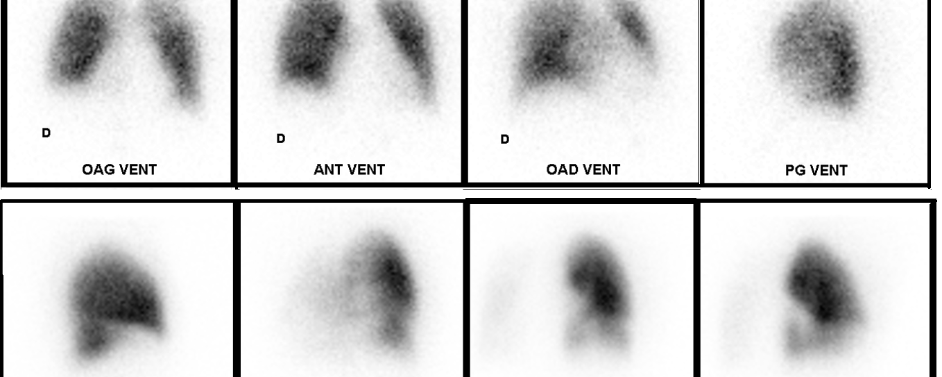 Sténose congénitale des artères pulmonaires