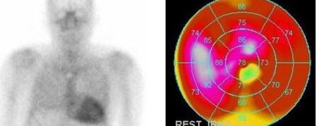 Amylose cardiaque à transthyrétine – Scintigraphie osseuse