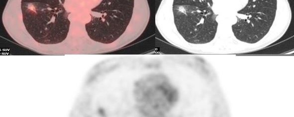 Lymphome de MALT pulmonaire – TEP FDG