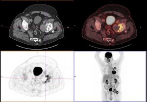 Granulome PTH TEP Mip challenge