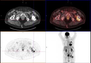 Granulome PTH gauche mip challenge 2