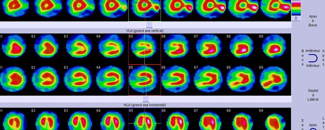 Fixation extra-cardiaque en scintigraphie myocardique au thallium