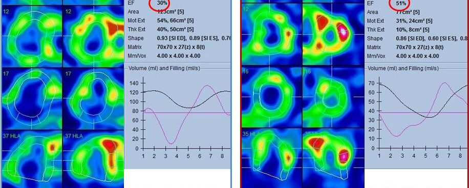 HTAP – Scintigraphie myocardique – Insuffisance cardiaque droite isolée à fonction VG conservée.