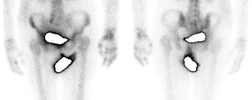 Algodystrophie post-AVC