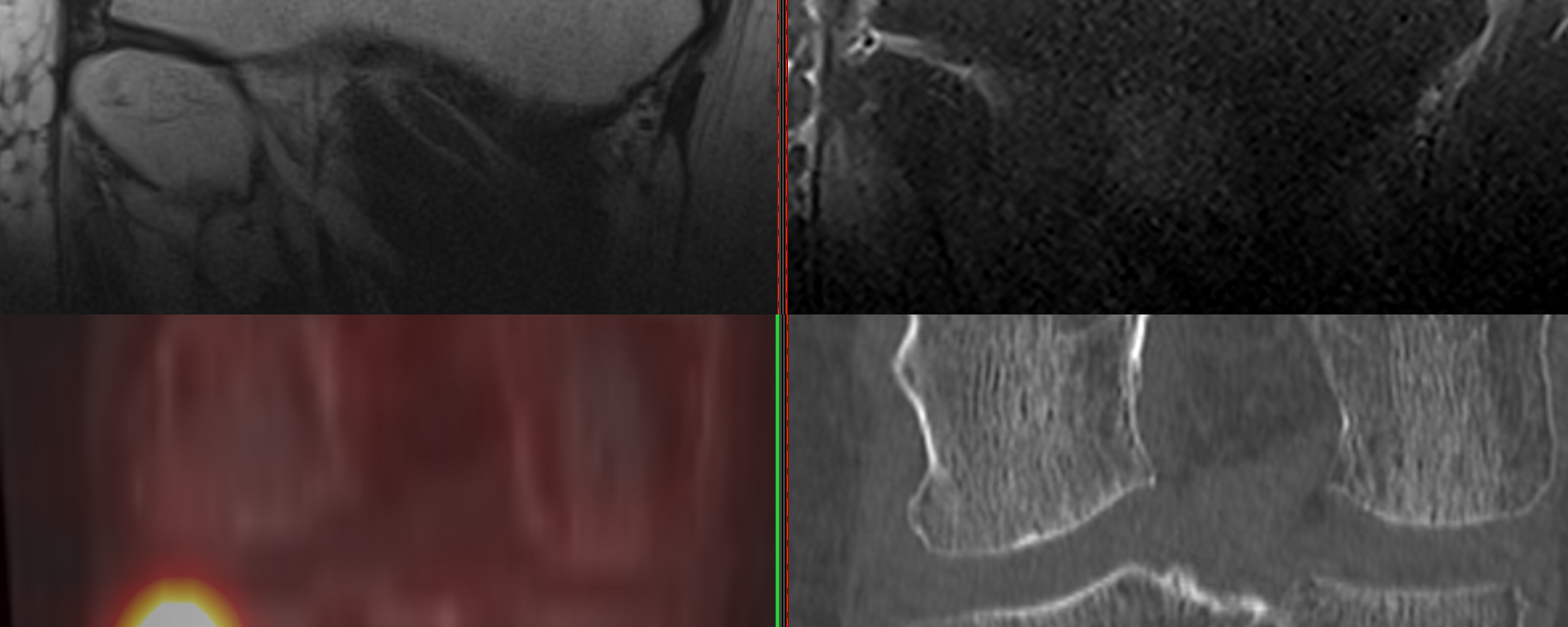 Fracture de contrainte du plateau tibial latéral droit