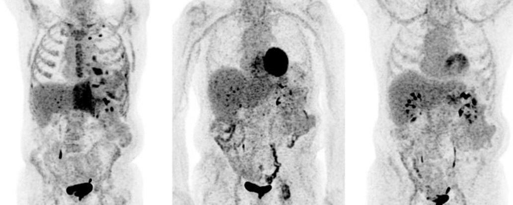 Une leucemie aigue lymphoblastique suivi en TEP FDG