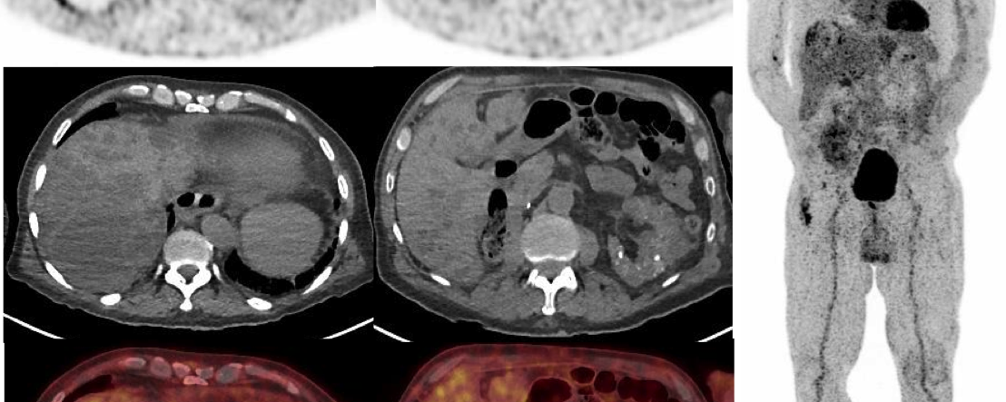 fièvre et syndrome inflammatoire