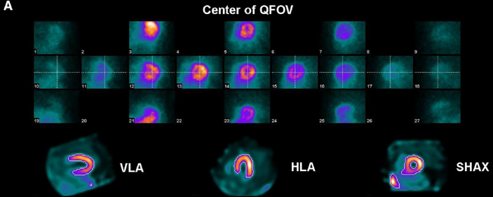 Artéfacts et pièges diagnostiques sur caméras CZT dédiées coeur