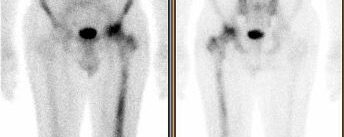 Lymphome osseux primitif