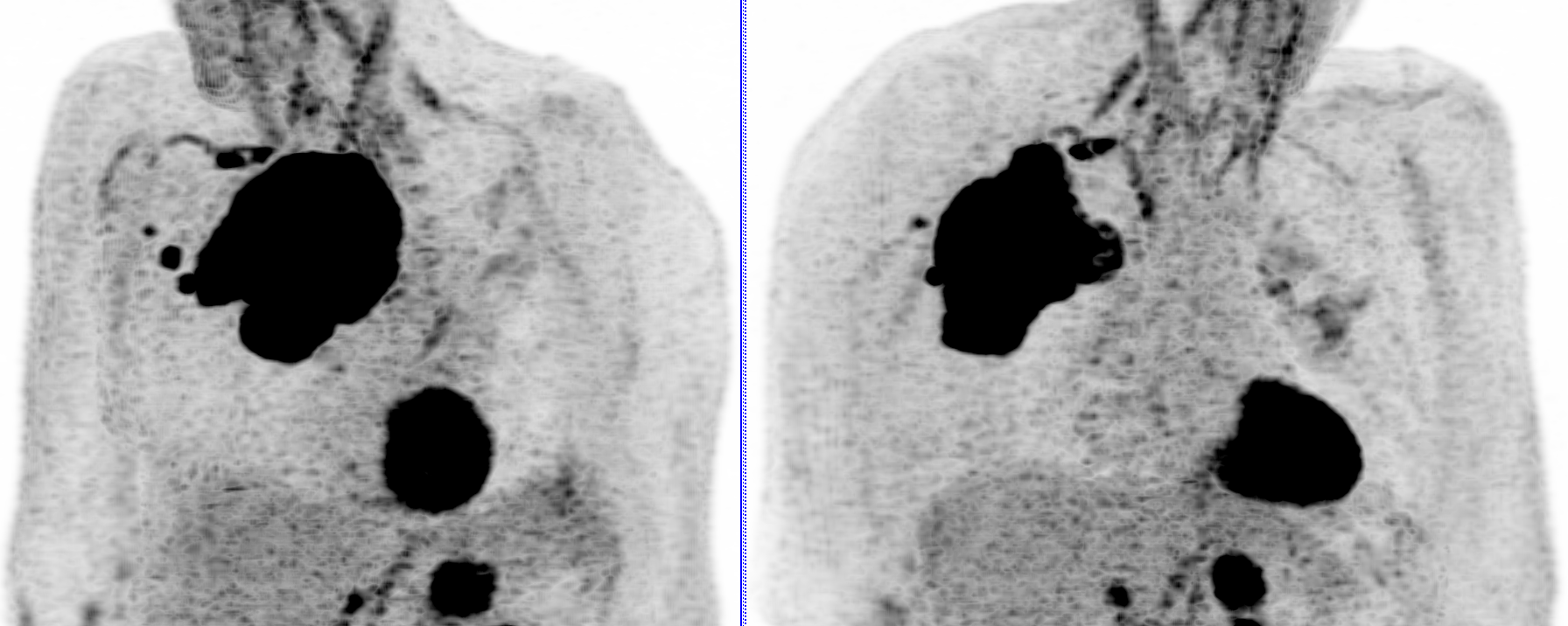 Thrombose veineuse supérieure en TEP FDG