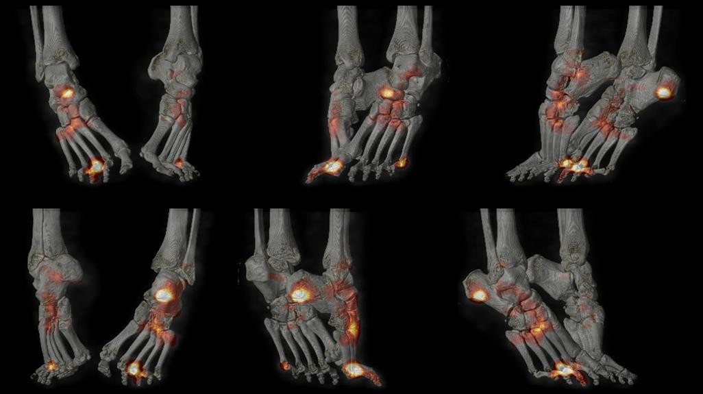 Spondylarthrite: rhumatisme psoriasique – Mednuc.net