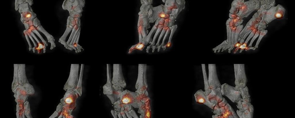 Spondylarthrite: rhumatisme psoriasique