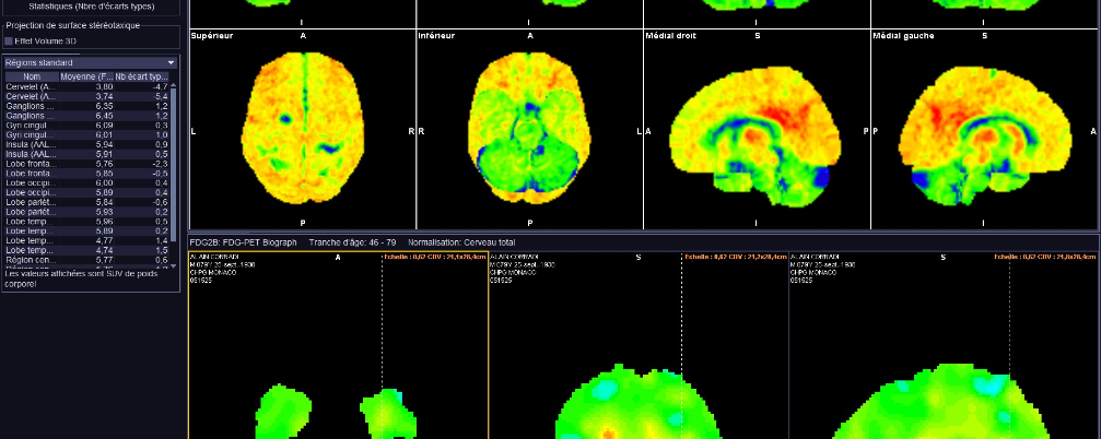 Syndrome parkinsonien