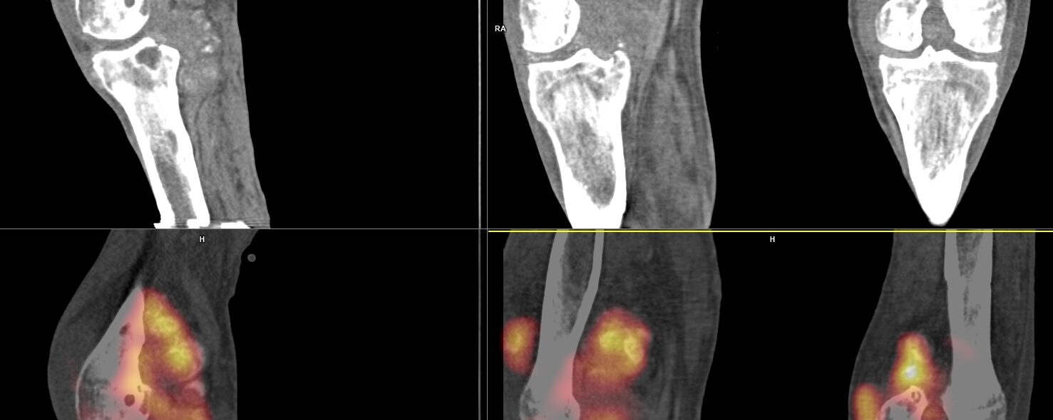 Chondrocalcinose articulaire – Mednuc.net