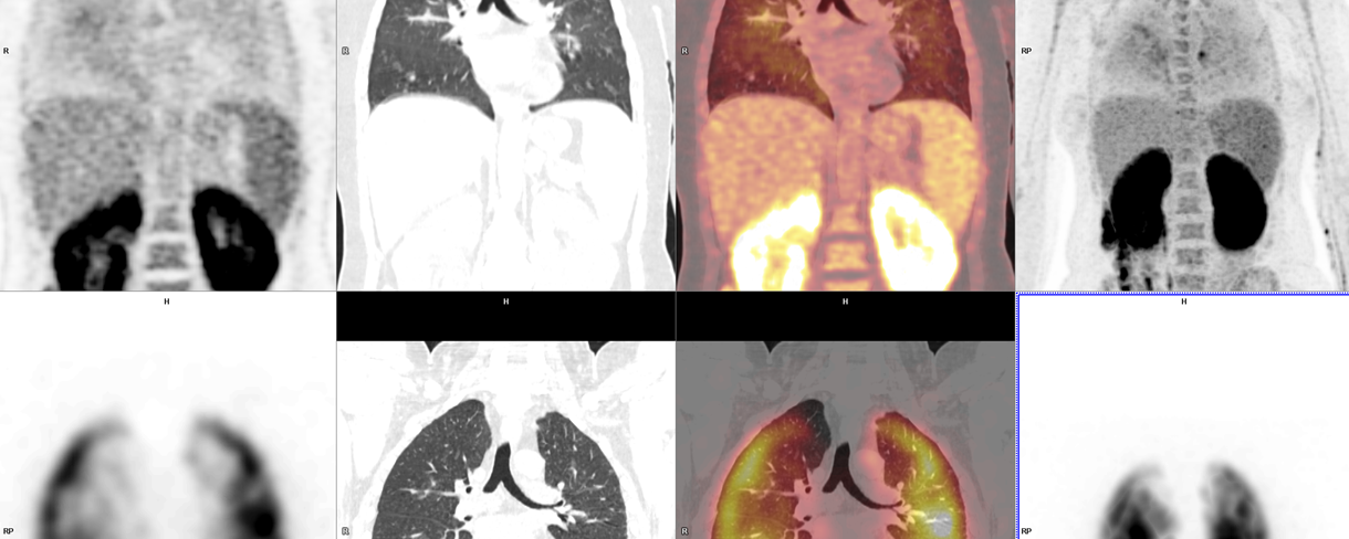 Lymphome intravasculaire à grandes cellules B