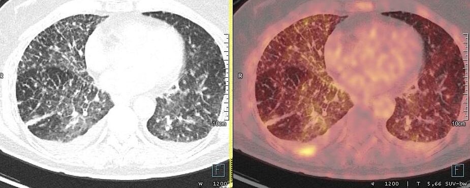 Micronodules pulmonaires