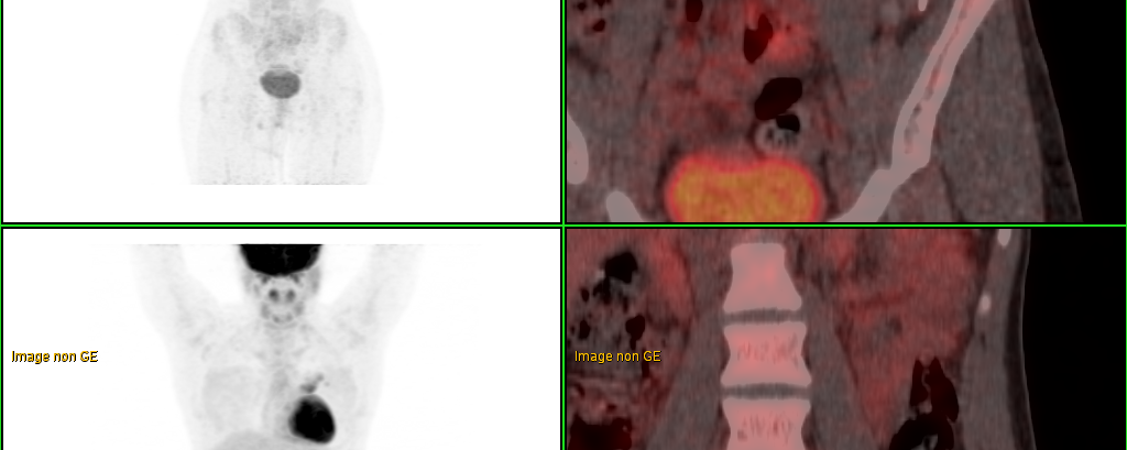 Piège en TEP-TDM au 18-FDG dans la pathologie pelvienne.