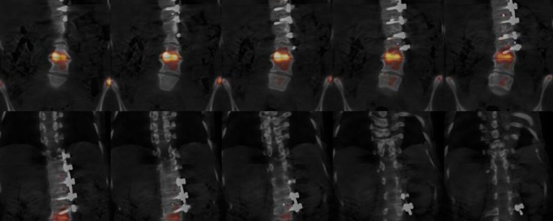 DMA sur arthrodèse thoraco-lombaire