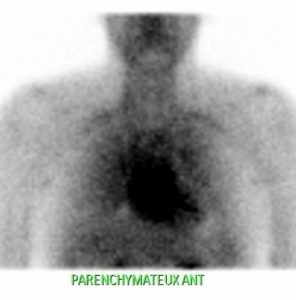 Scintigraphie osseuse - os acromial