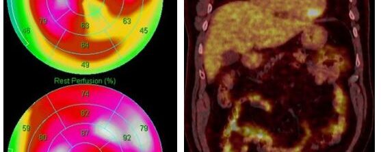 Ischémie myocardique découverte fortuitement en TEP-FDG