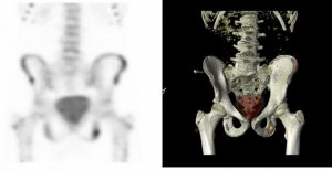 Osteochondrose ischiatique