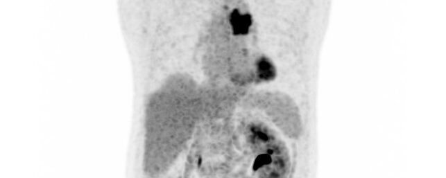 Dysphonie et ischémie myocardique en TEP FDG