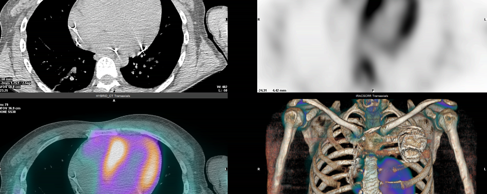 Amyloïdose cardiaque ATTR