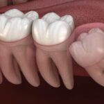 Illustration du profil de affordable wisdom tooth extraction