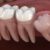 Illustration du profil de affordable wisdom tooth extraction